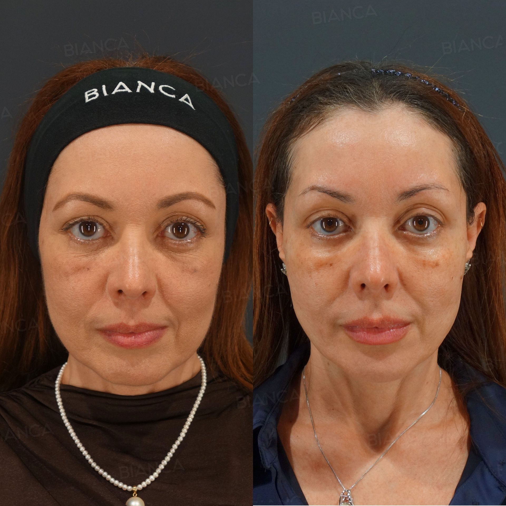 Thread lift before and after combined hyaluronic acid filler and botulinum toxin injection, front view at 1 month
