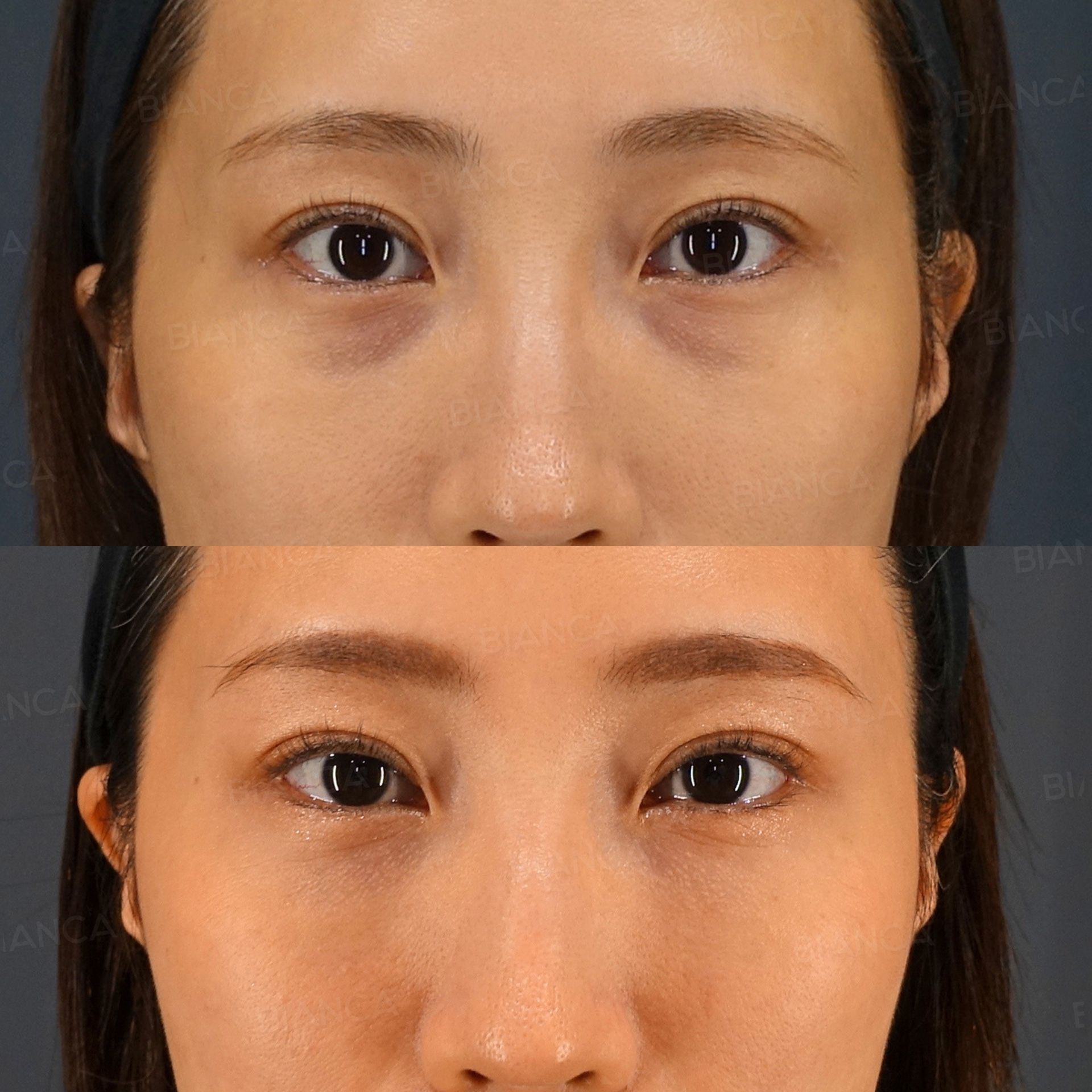 Lower blepharoplasty before and after a transconjunctival Hamra procedure repositioning the orbital fat over the rim, front view