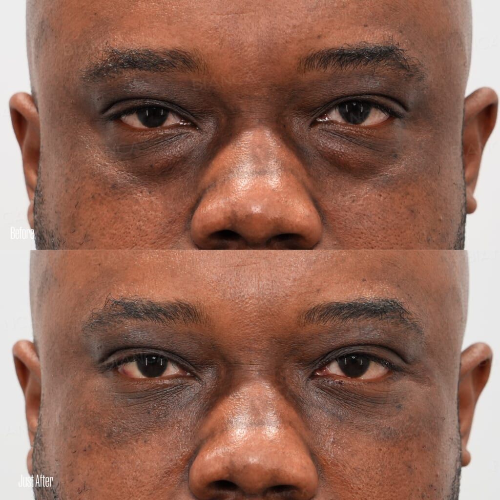 Under-Eye Dark Circle & Sagging Removal, Condensed Rich Fat (CRF) Injection