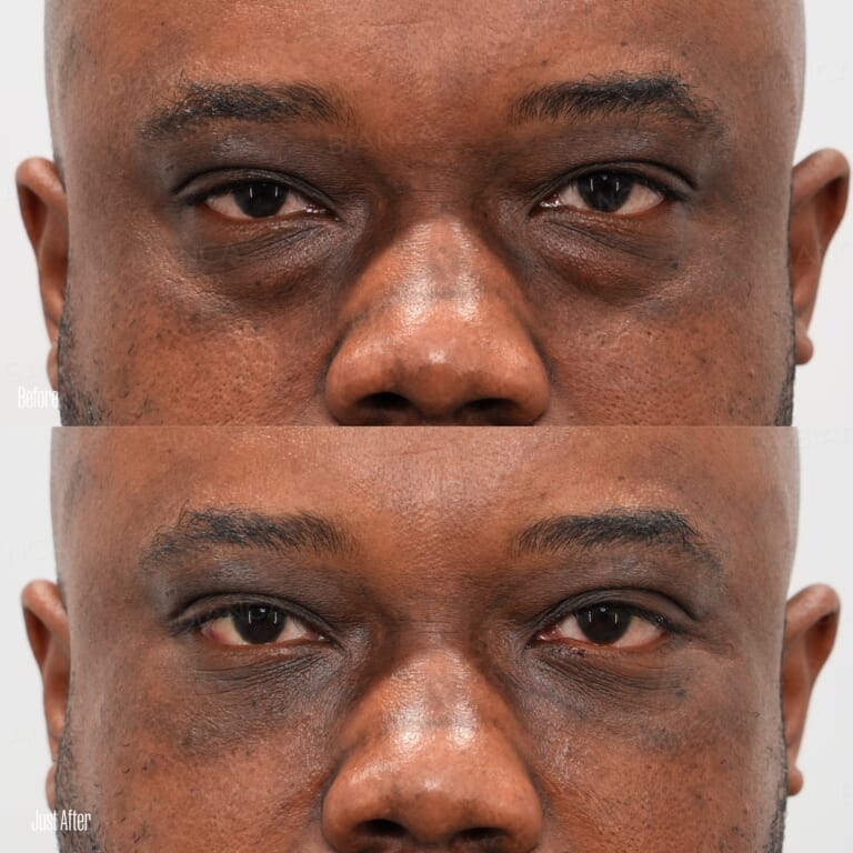Eye bag removal before and after under eye dark circle and sagging correction with condensed rich fat injection, front view, immediately after treatment