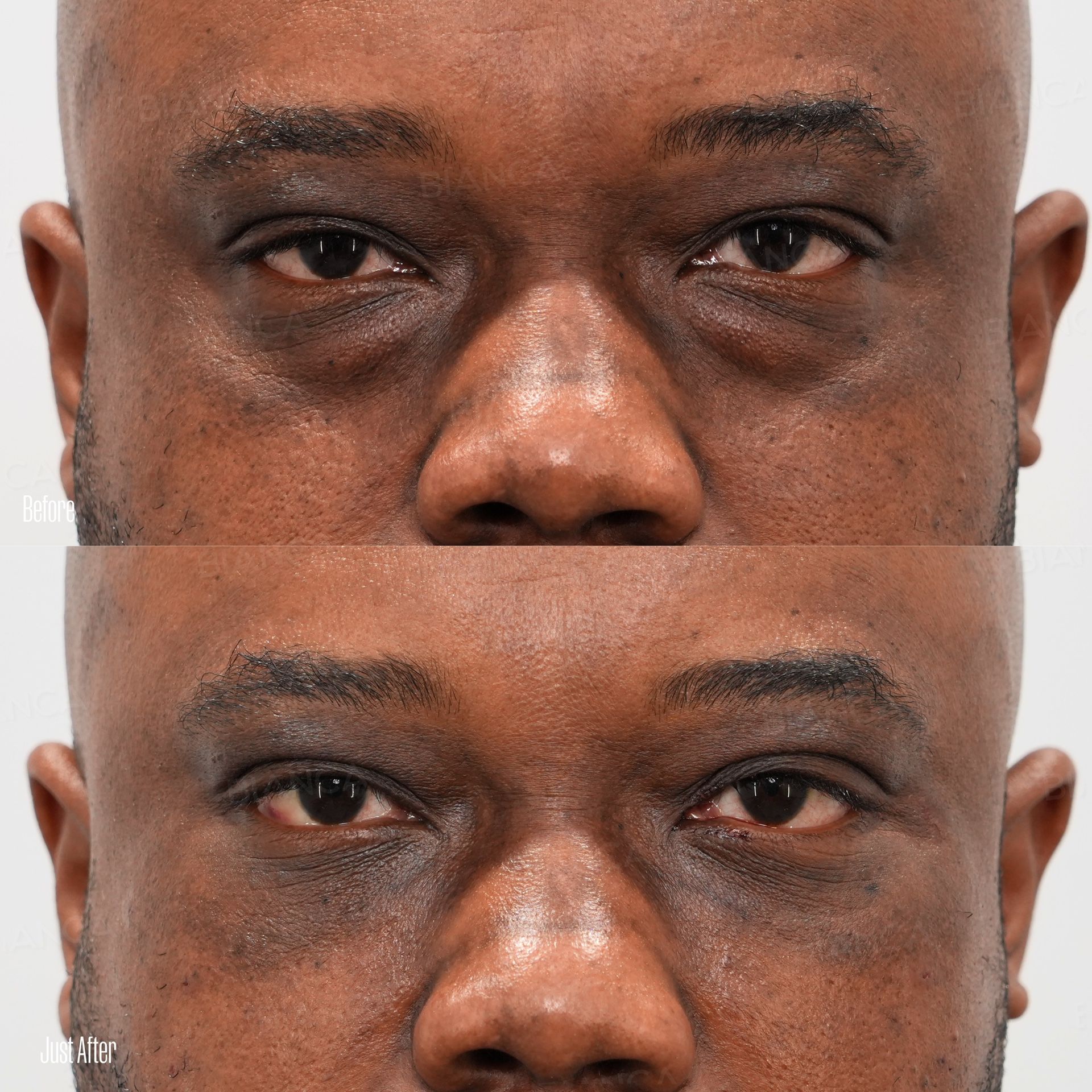 Under-Eye Dark Circle & Sagging Removal, Condensed Rich Fat (CRF) Injection