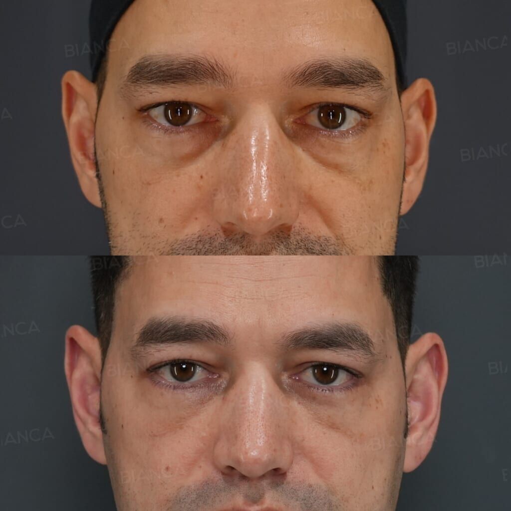 Under-Eye Dark Circle & Sagging Removal (Hamra Method)
