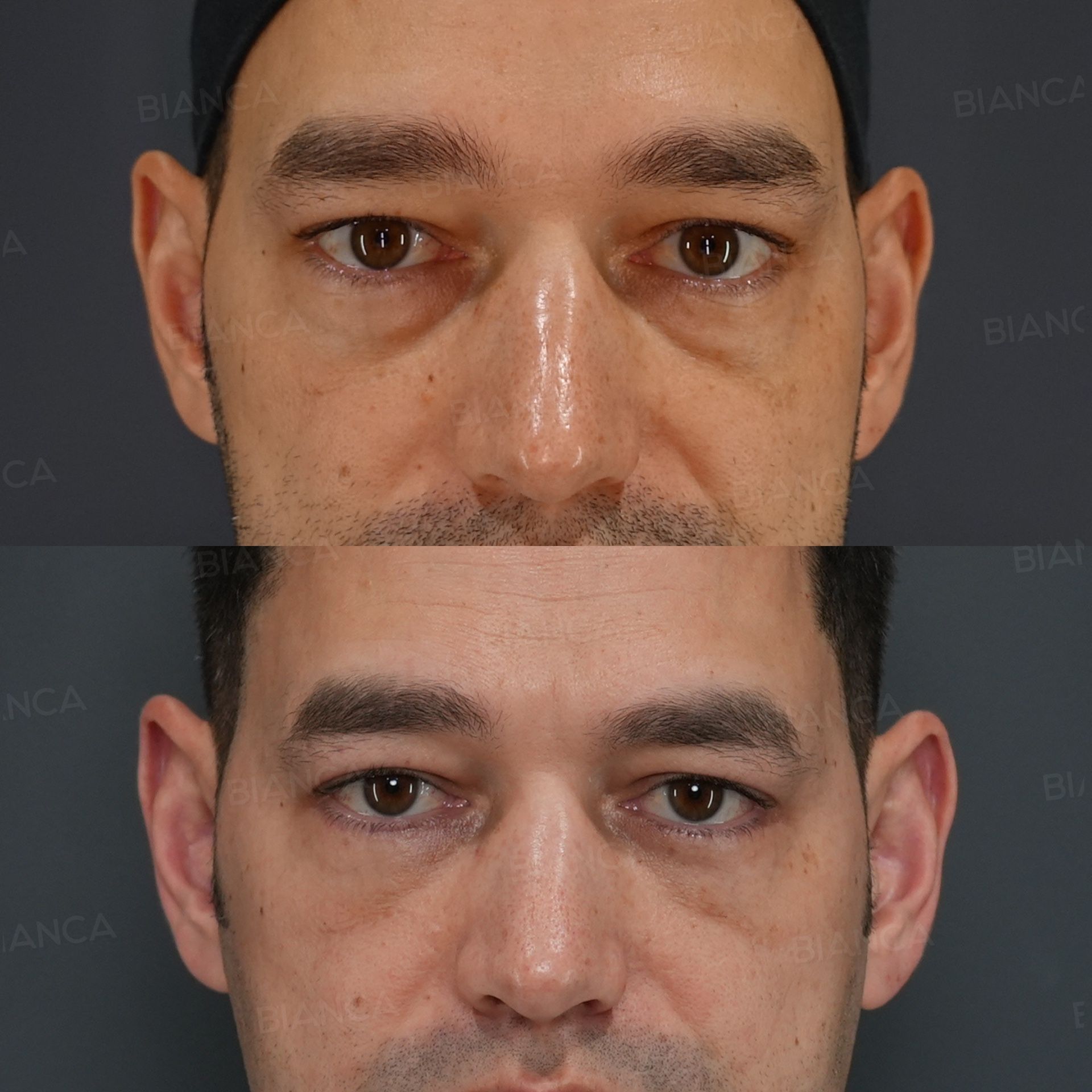 Under-Eye Dark Circle & Sagging Removal (Hamra Method)