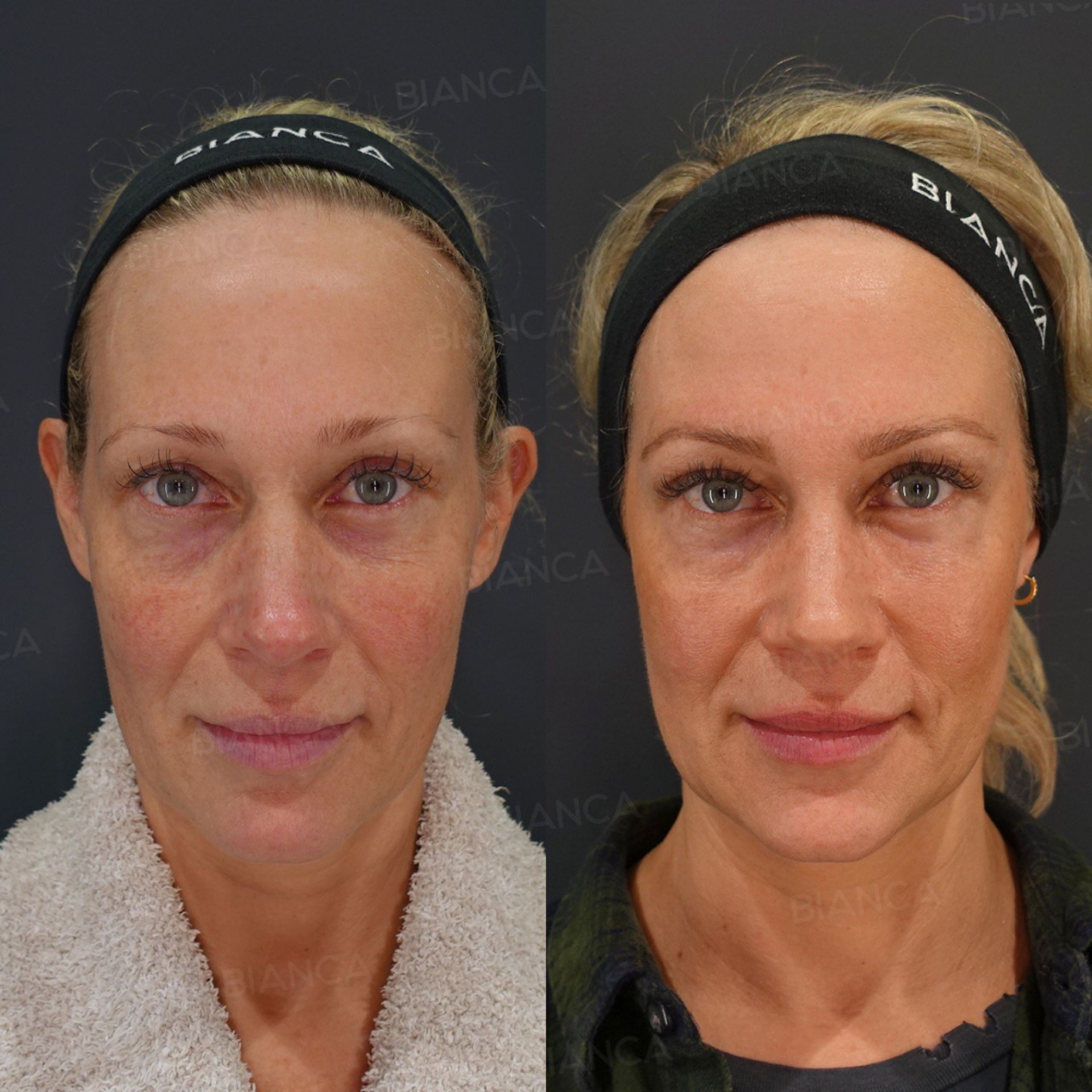 Under-Eye Fat Grafting, Upper Blepharoplasty