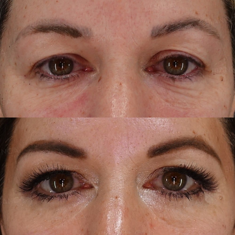 Upper Blepharoplasty + Morpheus8 (Around the Eyes) before and after, 1 month, BIANCA CLINIC Tokyo