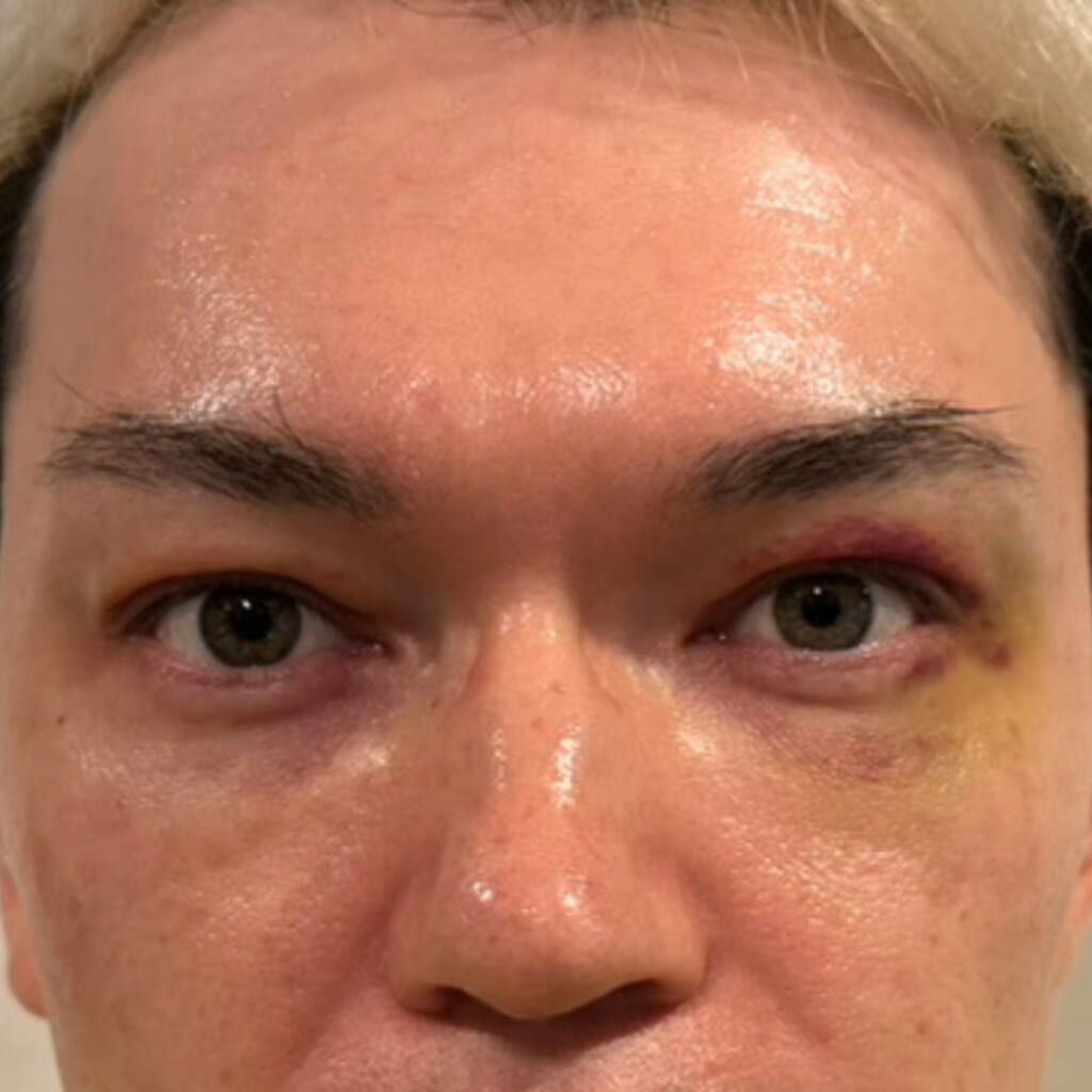 UPPER EYELID SAGGING REMOVAL-day7