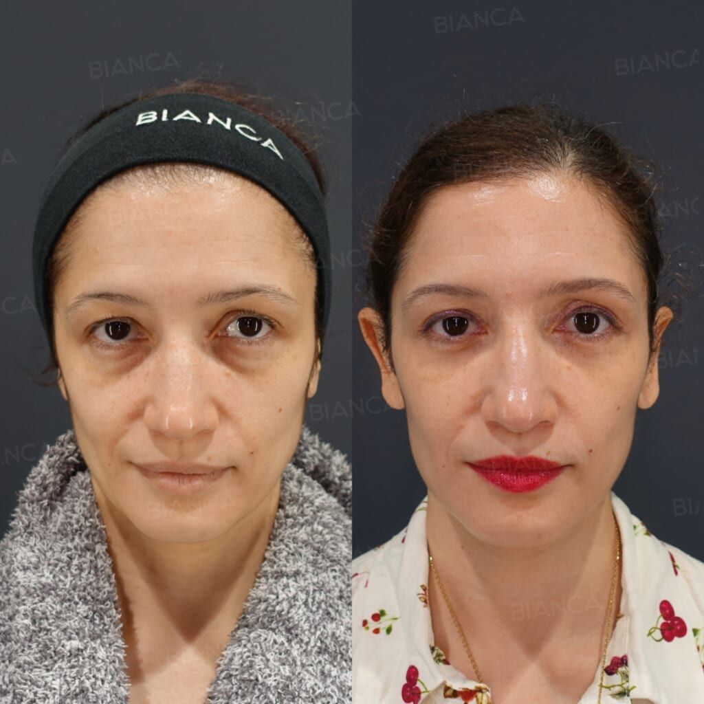 Upper Eyelid Skin Excision (Upper Blepharoplasty)