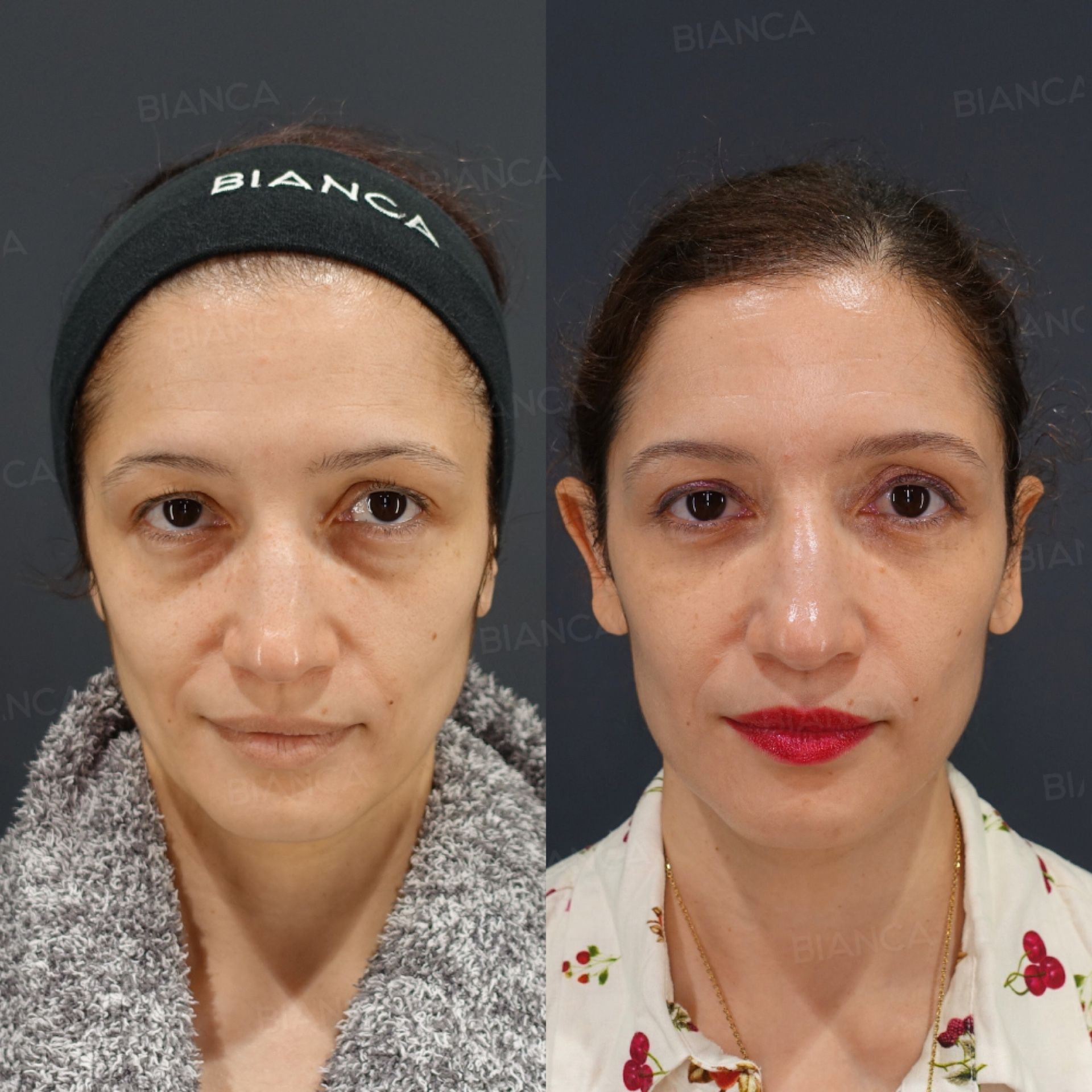 Upper Eyelid Skin Excision (Upper Blepharoplasty)