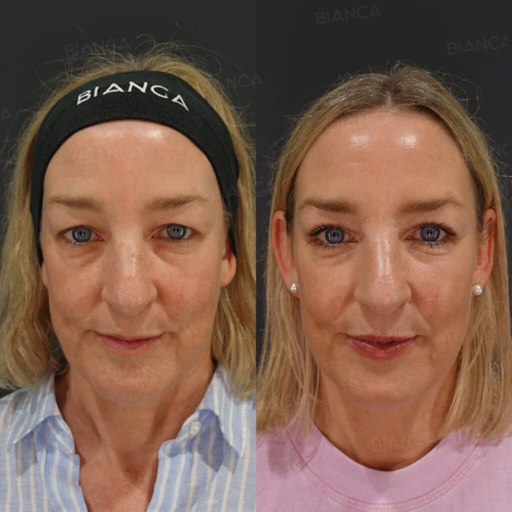 Upper Eyelid Skin Excision (Upper Blepharoplasty)