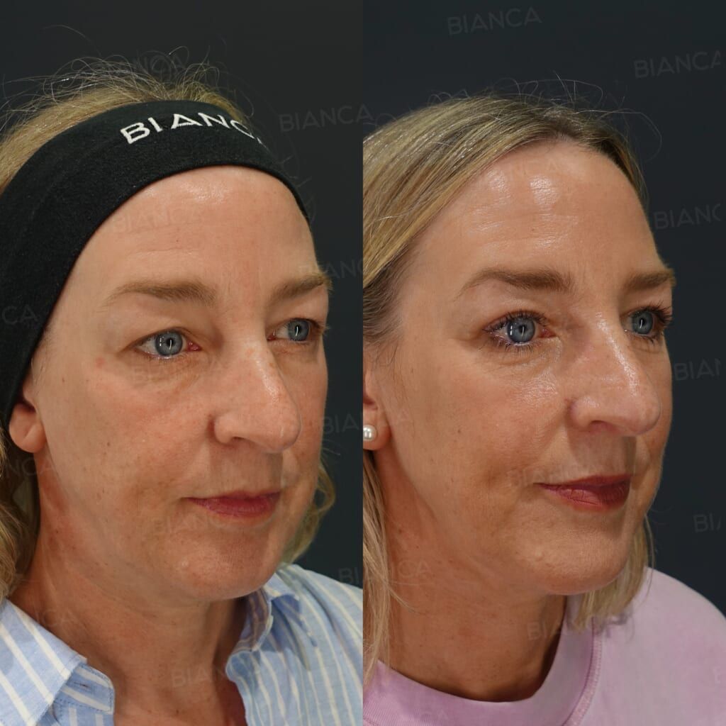 Upper Eyelid Skin Excision (Upper Blepharoplasty)