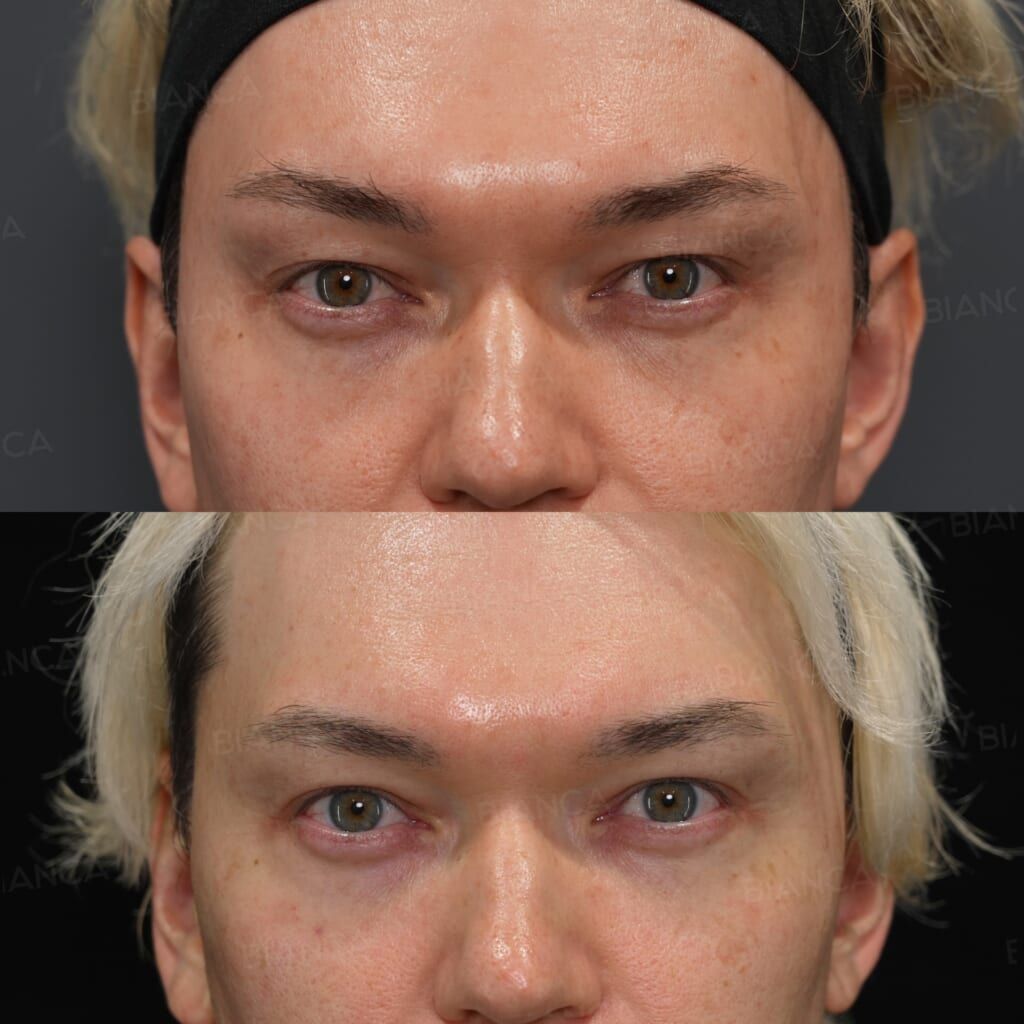 Upper Eyelid Skin Excision (Upper Blepharoplasty)