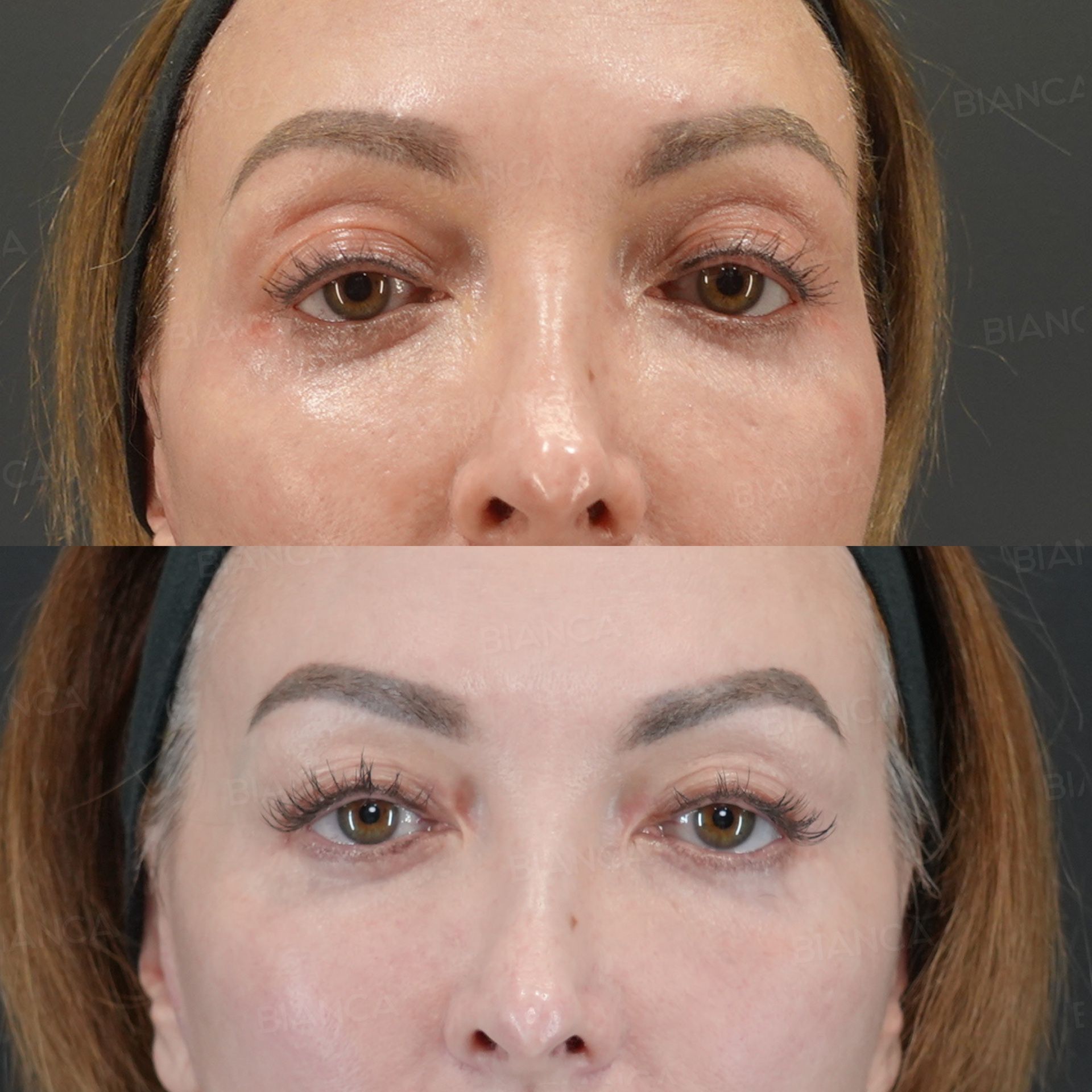 Upper blepharoplasty before and after excision of excess upper eyelid skin along the natural crease, front view at 6 months