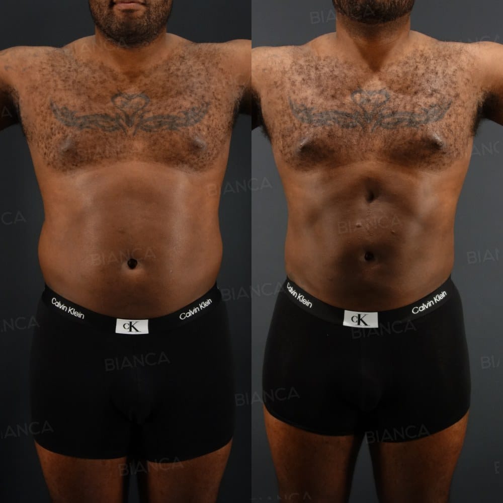 VASER Abcracks (Abdominal Etching) before and after, 1 month, BIANCA CLINIC Tokyo