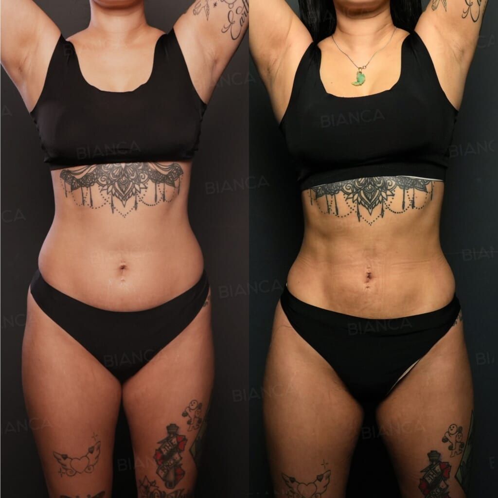VASER Liposuction (Axilla, Upper Arms, Upper Abdomen, Lower Abdomen, Flanks), Quantum Body (Lower Abdomen)