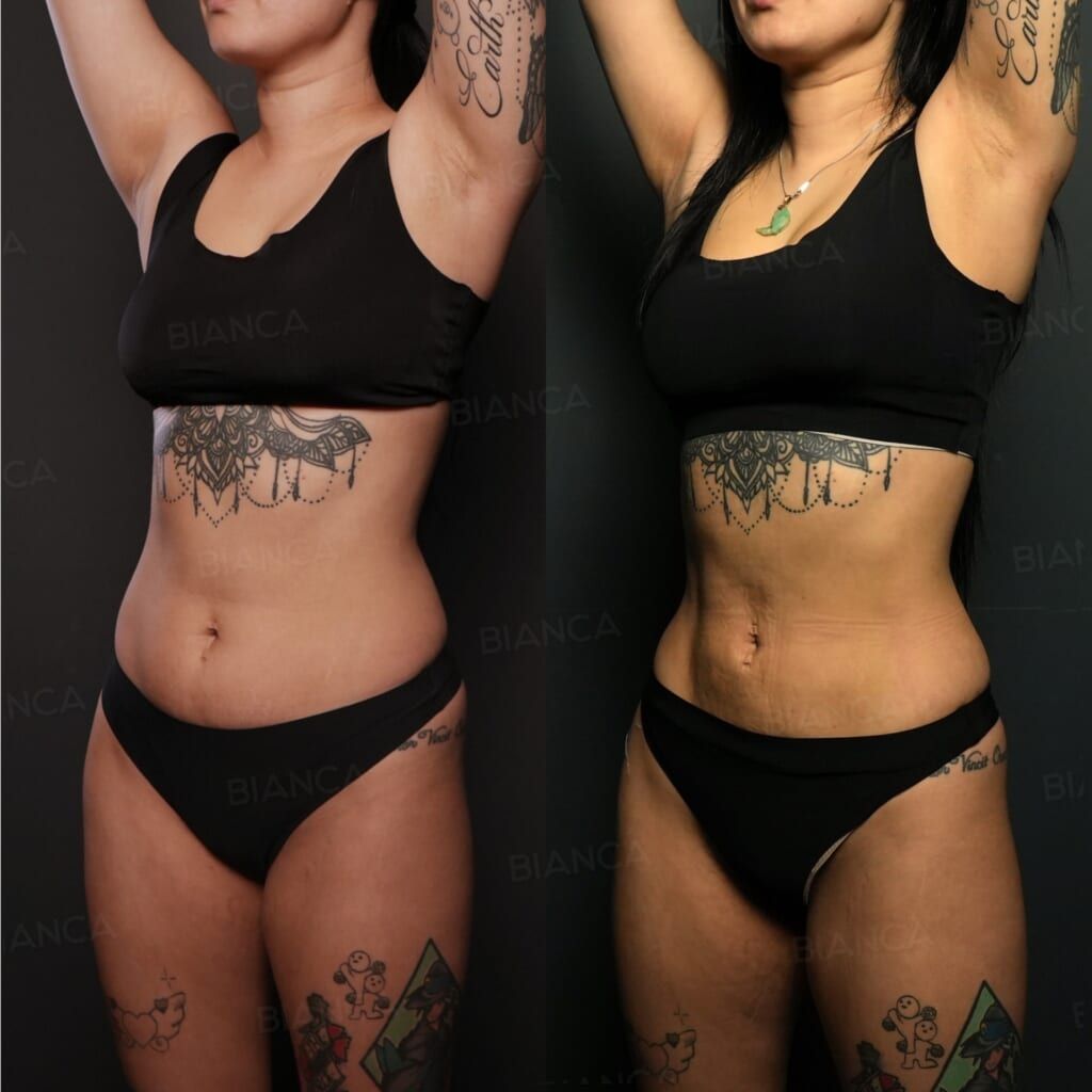 VASER Liposuction (Axilla, Upper Arms, Upper Abdomen, Lower Abdomen, Flanks), Quantum Body (Lower Abdomen)
