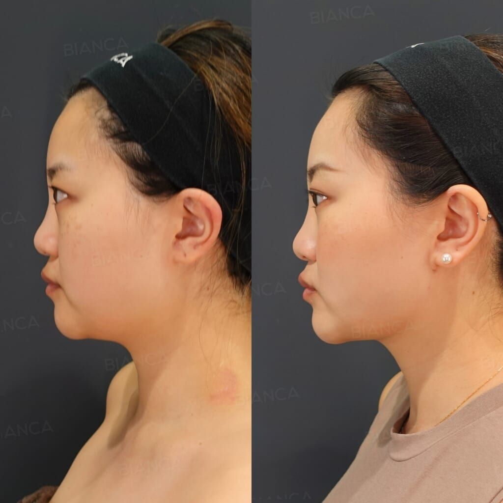 VASER Liposuction (Jawline, Submental)