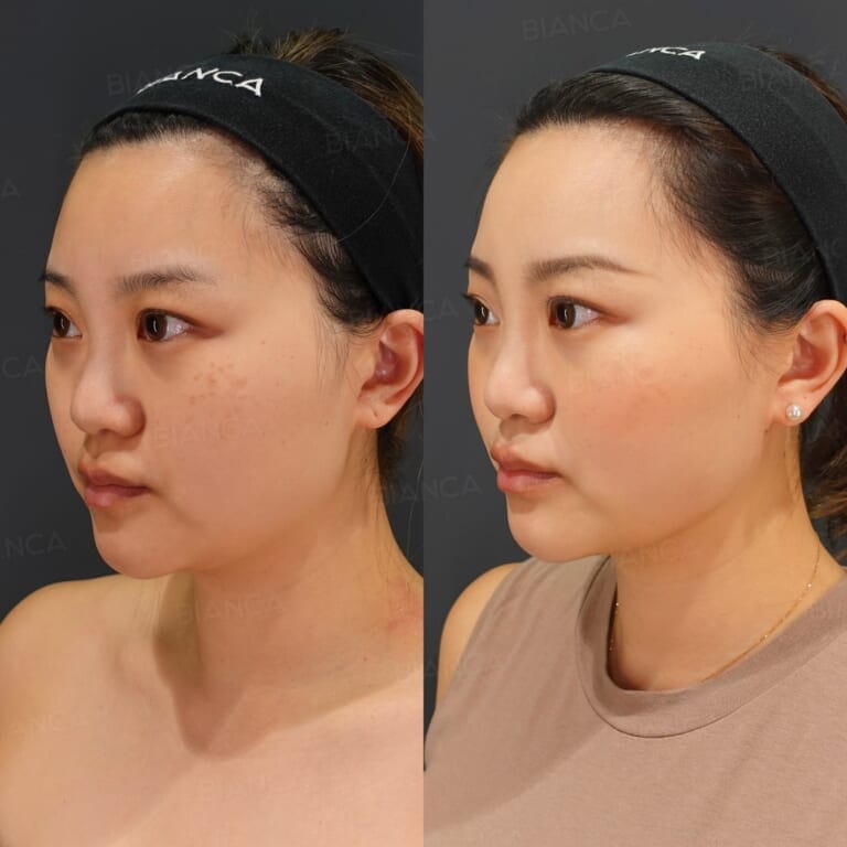 Facial liposuction before and after VASER removal of fat along the jawline and under the chin, three-quarter view at 1 month
