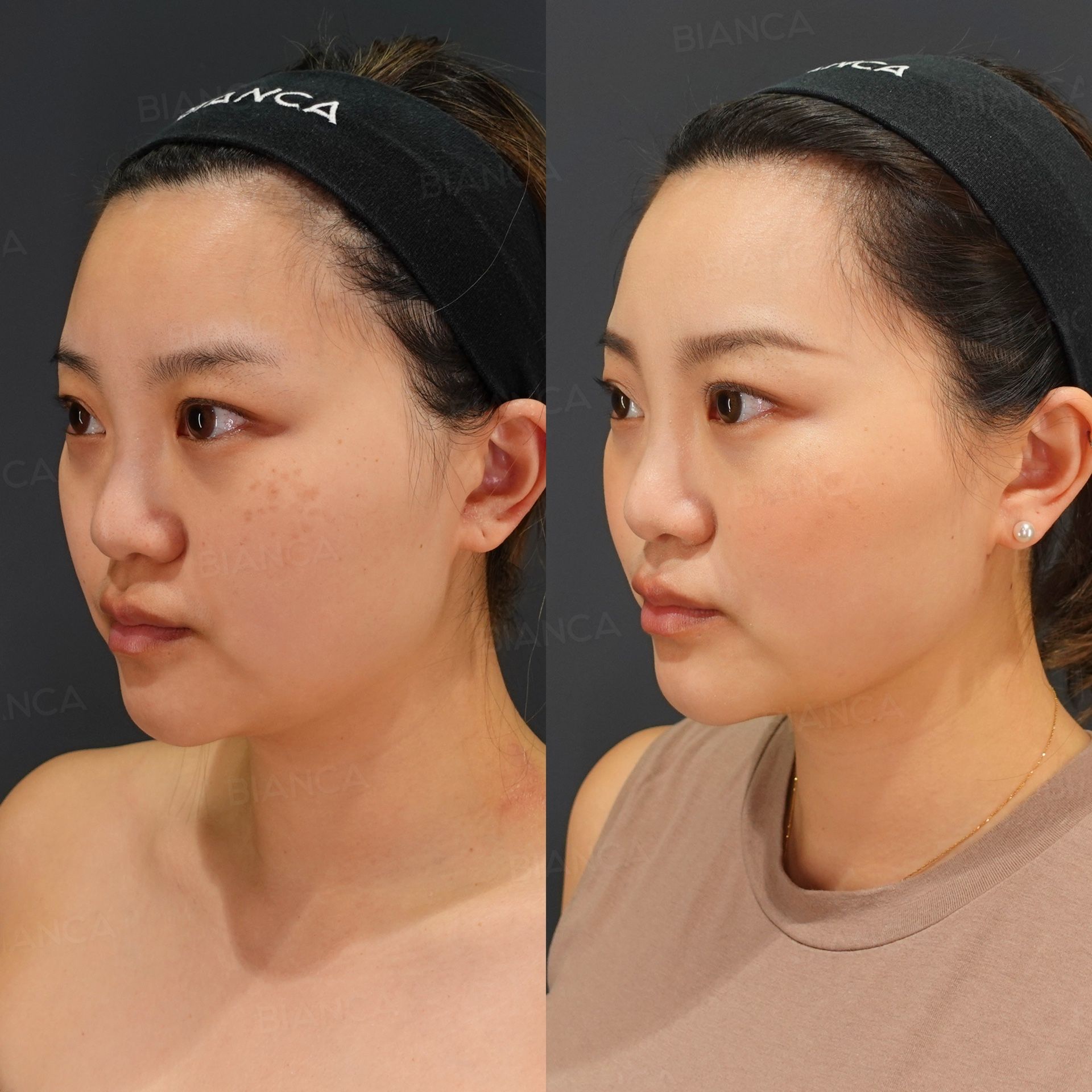 Facial liposuction before and after VASER removal of fat along the jawline and under the chin, three-quarter view at 1 month
