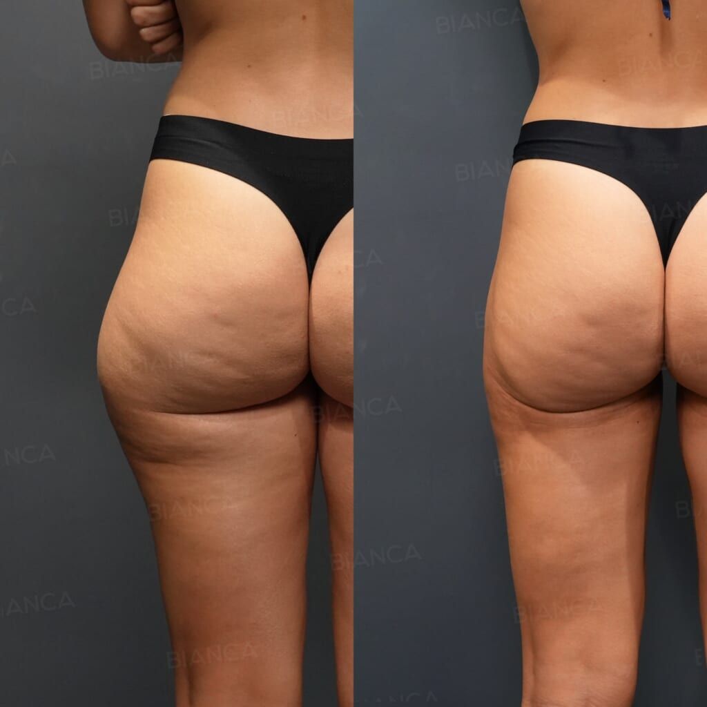 VASER Liposuction (Posterior Thighs, Outer Thighs), Quantum RF Body (Posterior Thighs, Outer Thighs)