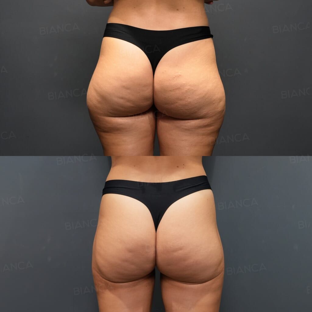 VASER Liposuction (Posterior Thighs, Outer Thighs), Quantum RF Body (Posterior Thighs, Outer Thighs)