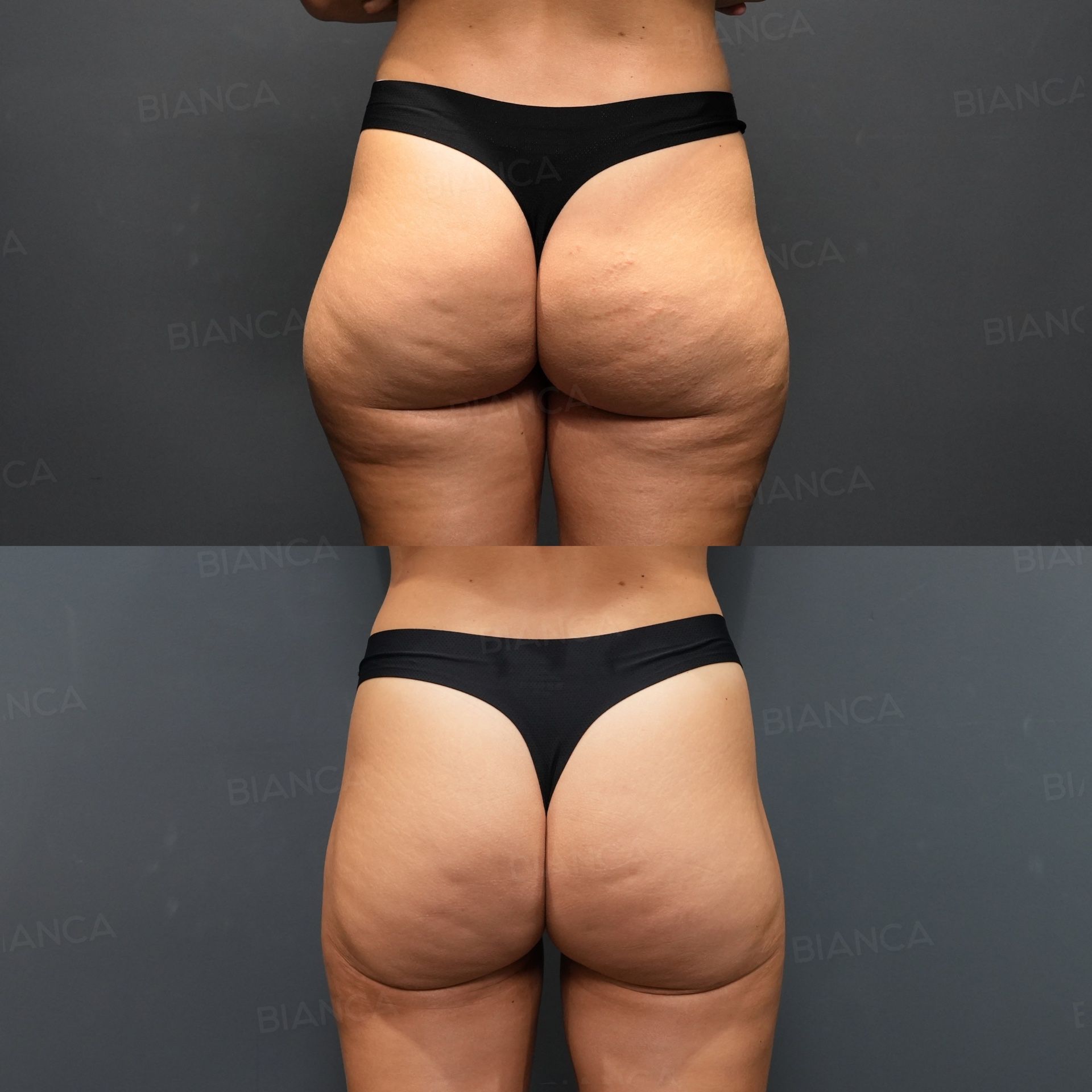 VASER Liposuction (Posterior Thighs, Outer Thighs), Quantum RF Body (Posterior Thighs, Outer Thighs)