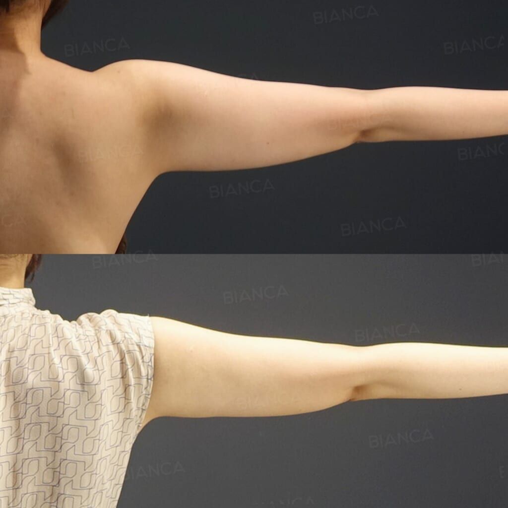 VASER Liposuction (Upper Arms)