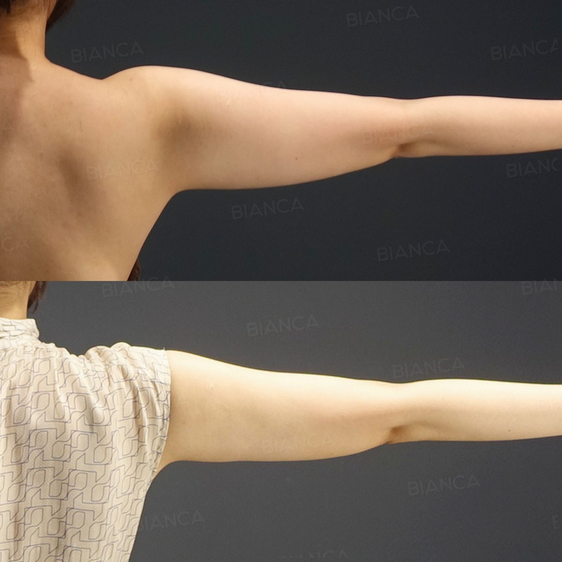 VASER Liposuction (Upper Arms)