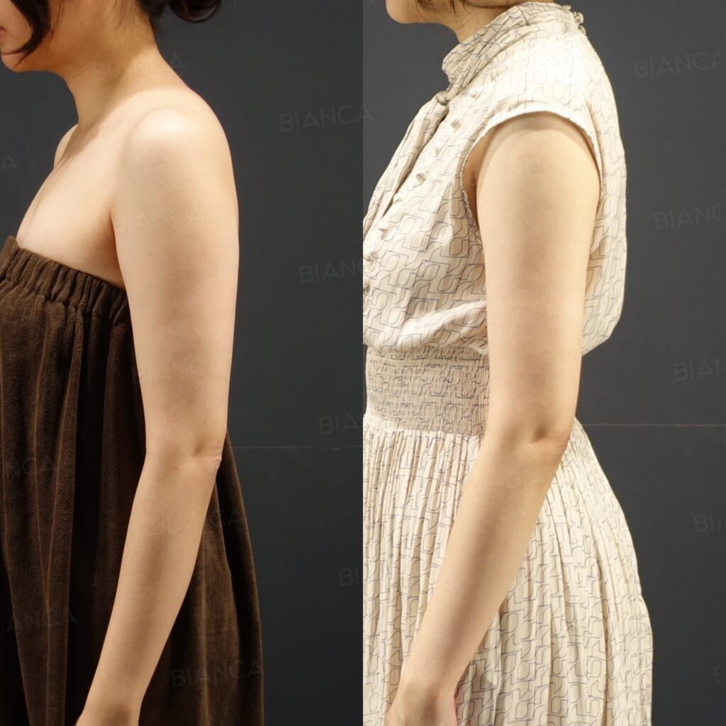 VASER Liposuction (Upper Arms)
