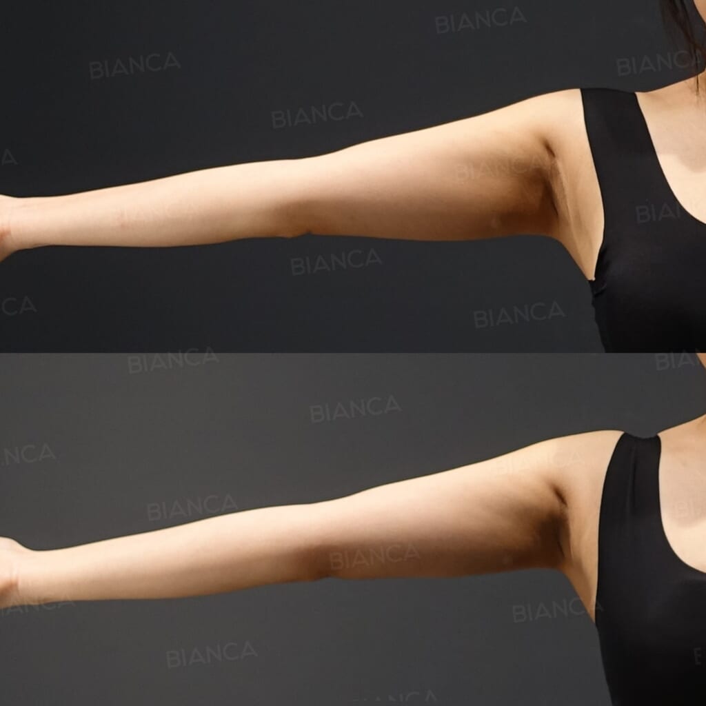 VASER Liposuction (Upper Arms and Behind Underarms) before and after, 3 months, BIANCA CLINIC Tokyo