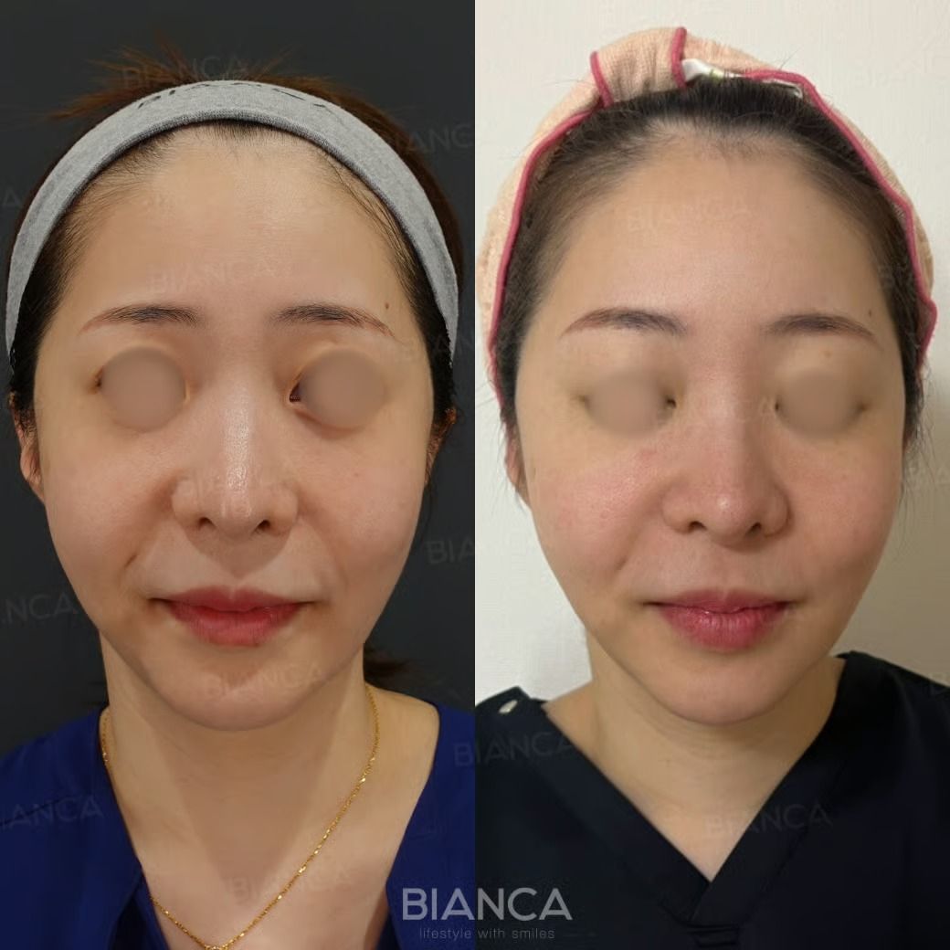 Before and after photo of Volneuma skin tightening treatment, showing the right side before procedure and the left side one week after procedure.