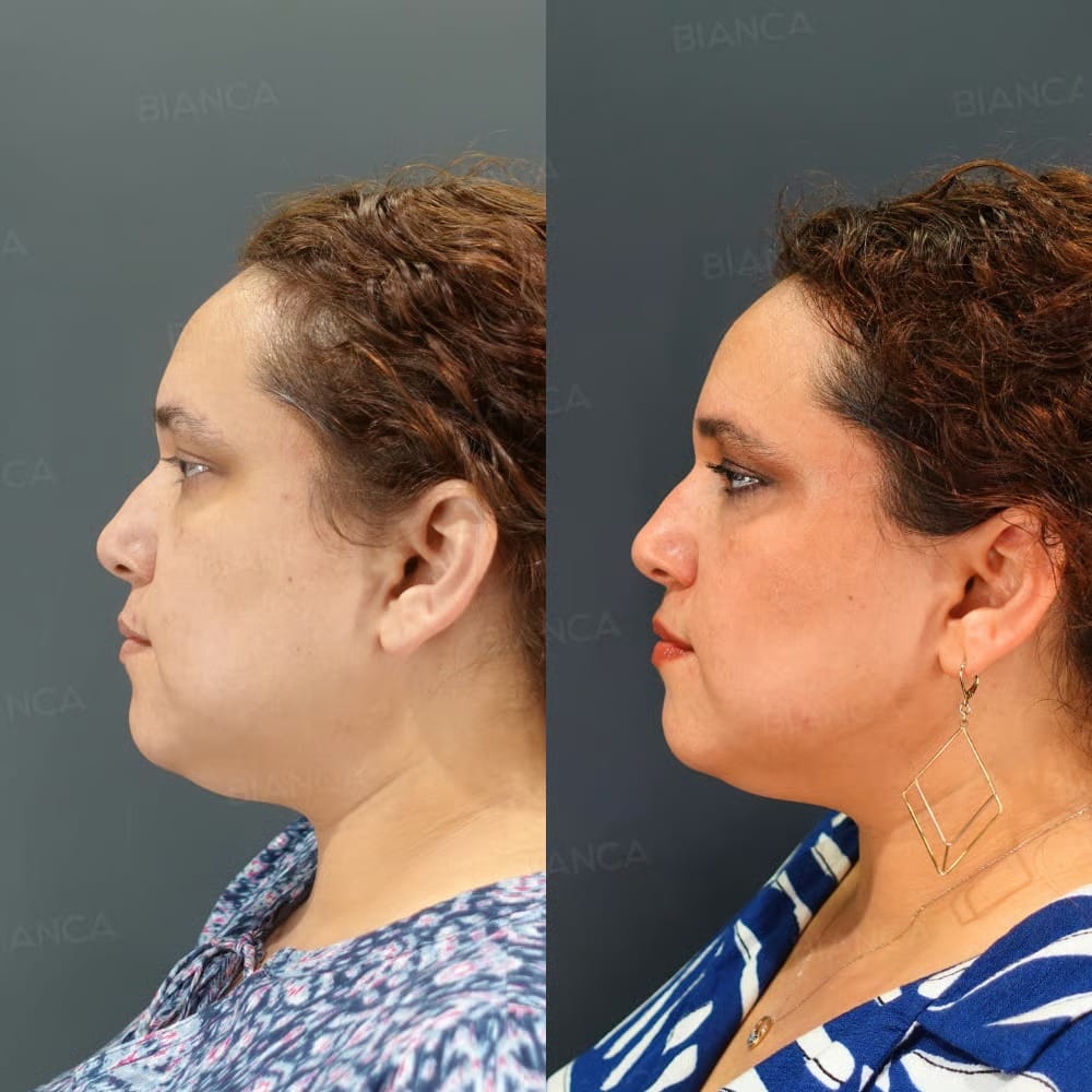 Volneuma and HIFU combination treatment before (left) and 1 month after (right). Jawline tightening and sagging improvement.