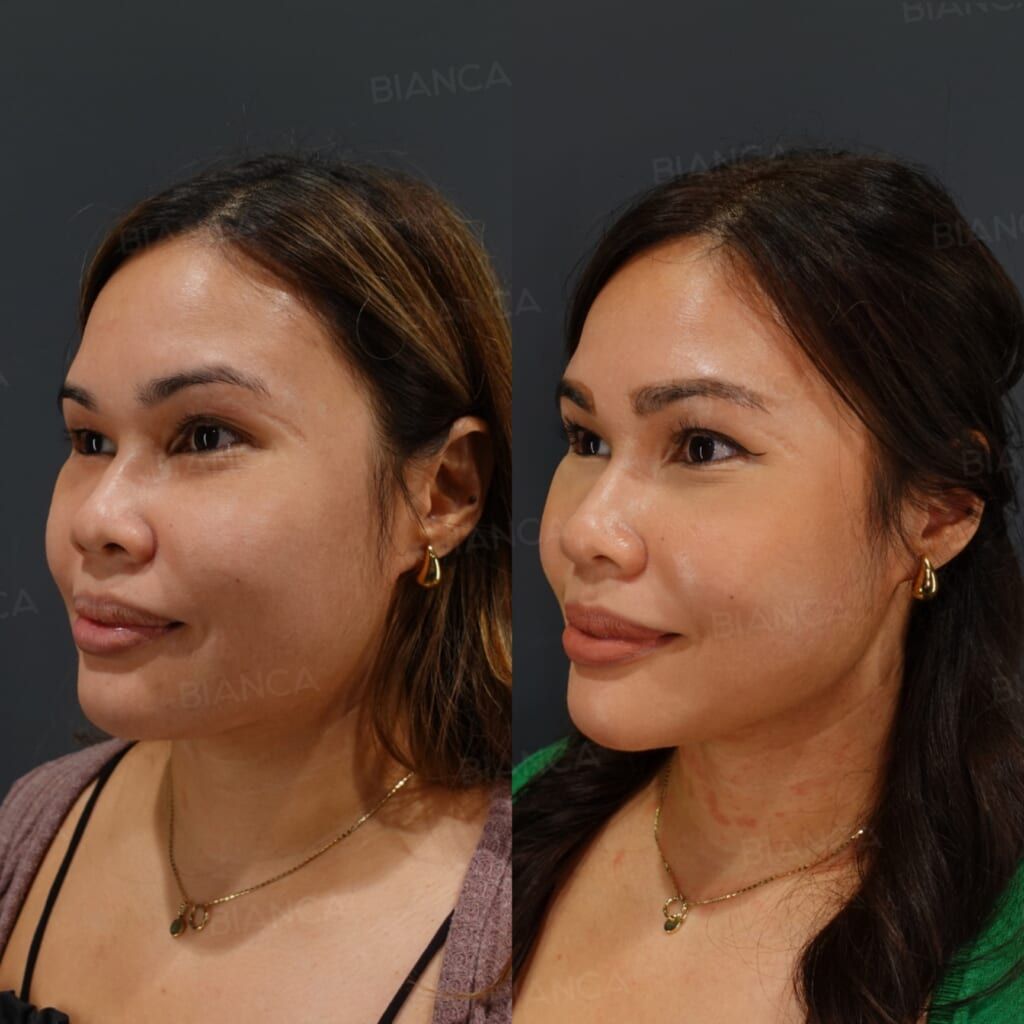 Volnewmer (Face, Submental), HIFU (Ultracell Zi, Face, Submental)