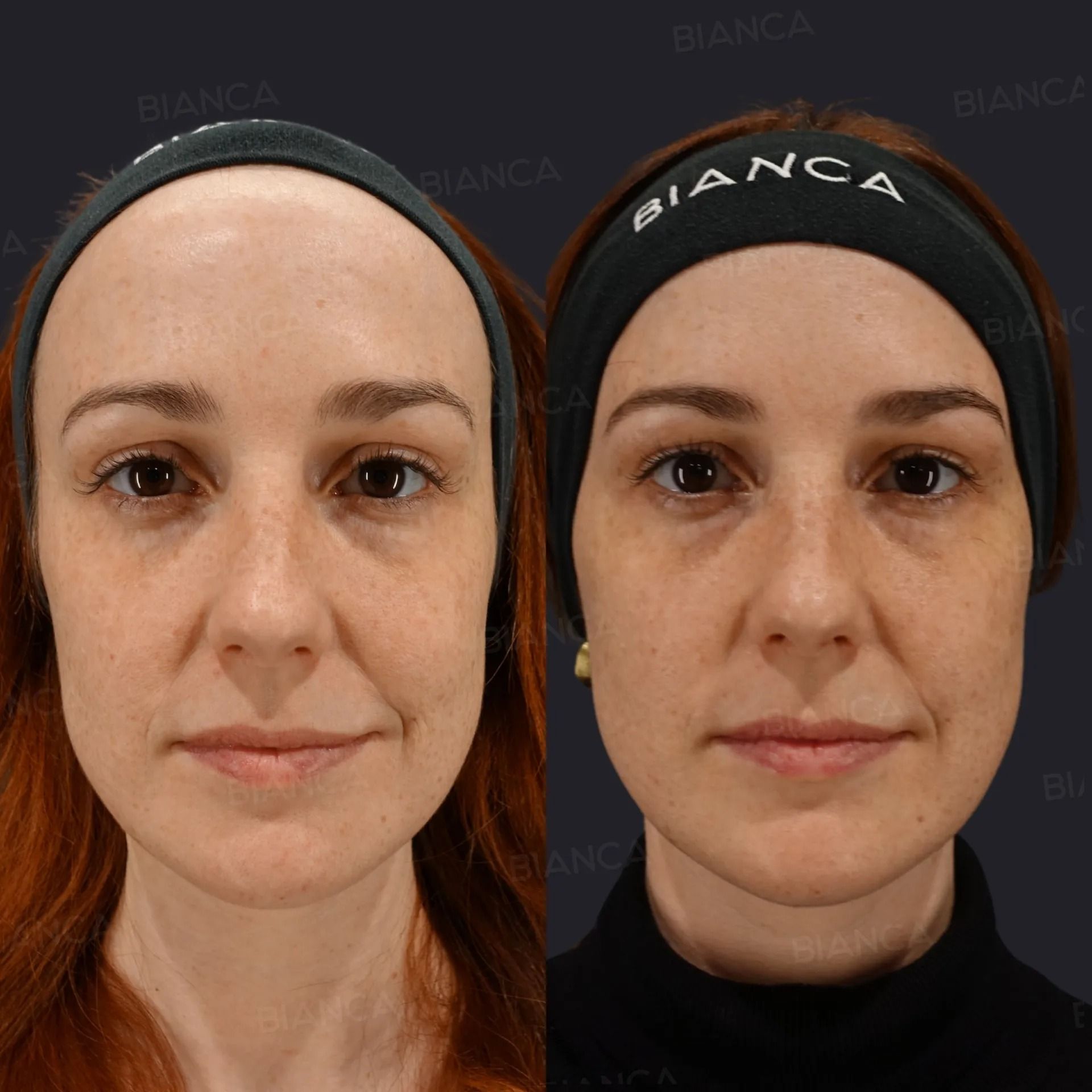Before and 1 month after Volnewmer and HIFU treatment showing skin tightening and facial contouring results.