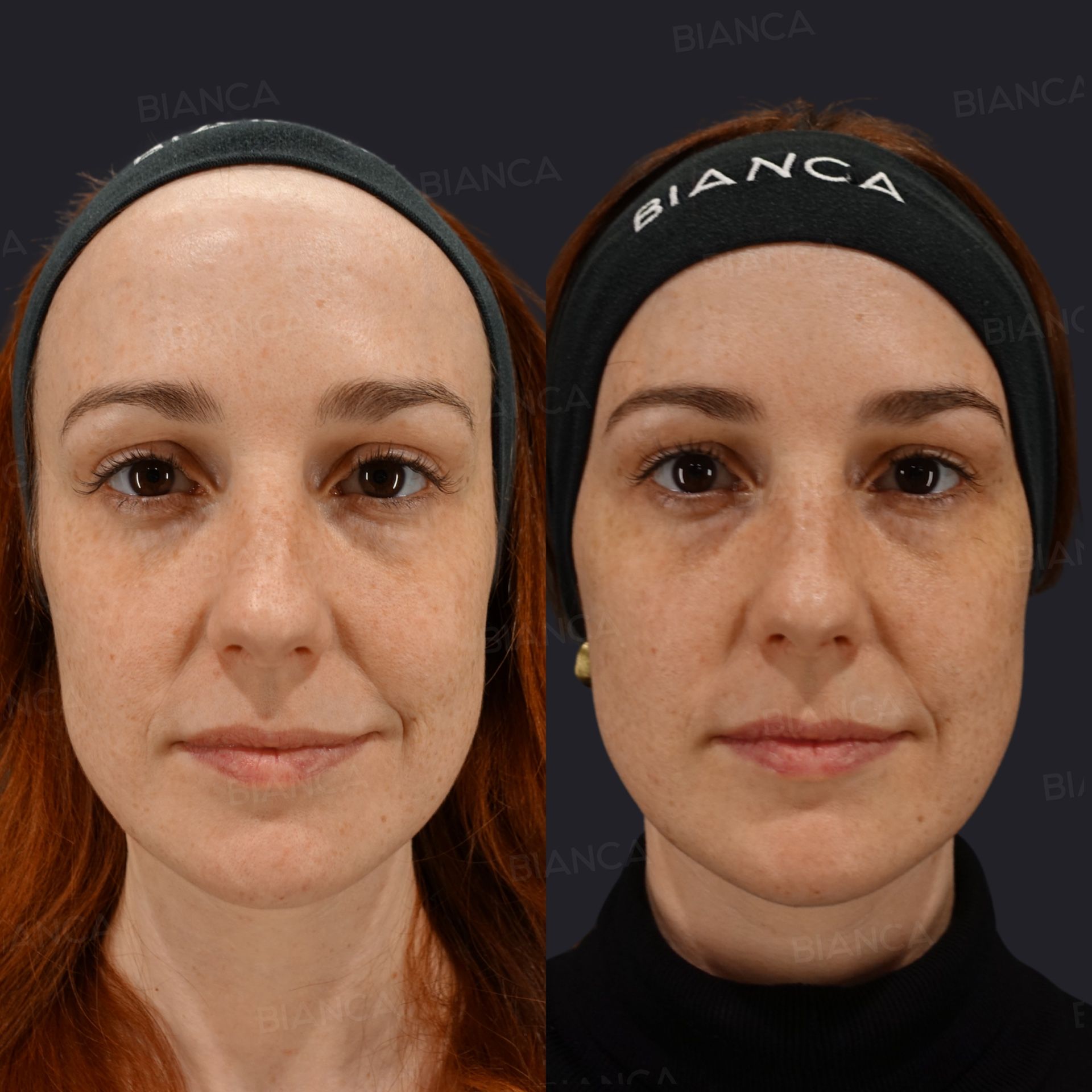 Radiofrequency skin tightening before and after Volnewmer combined with Ultracell Zi focused ultrasound, front view at 1 month