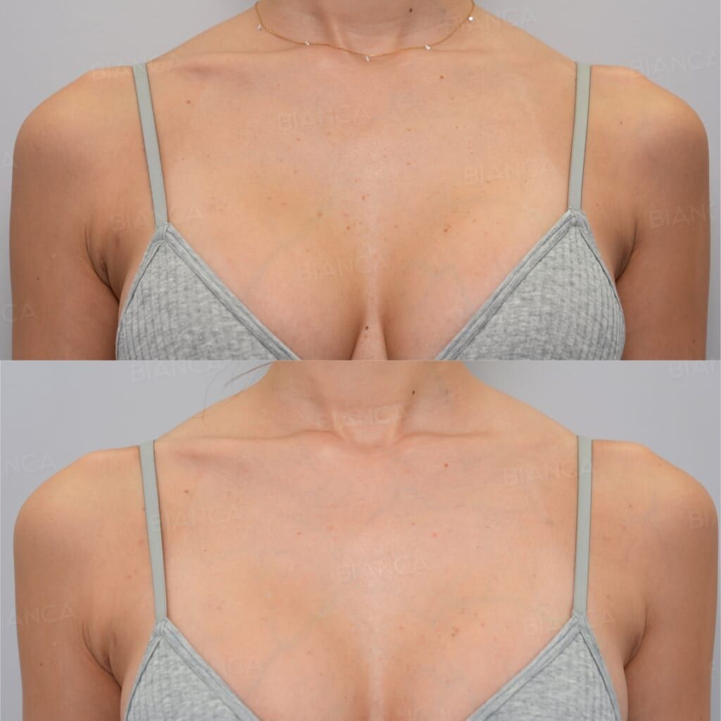 Wart and Spot Removal (Décolletage)
