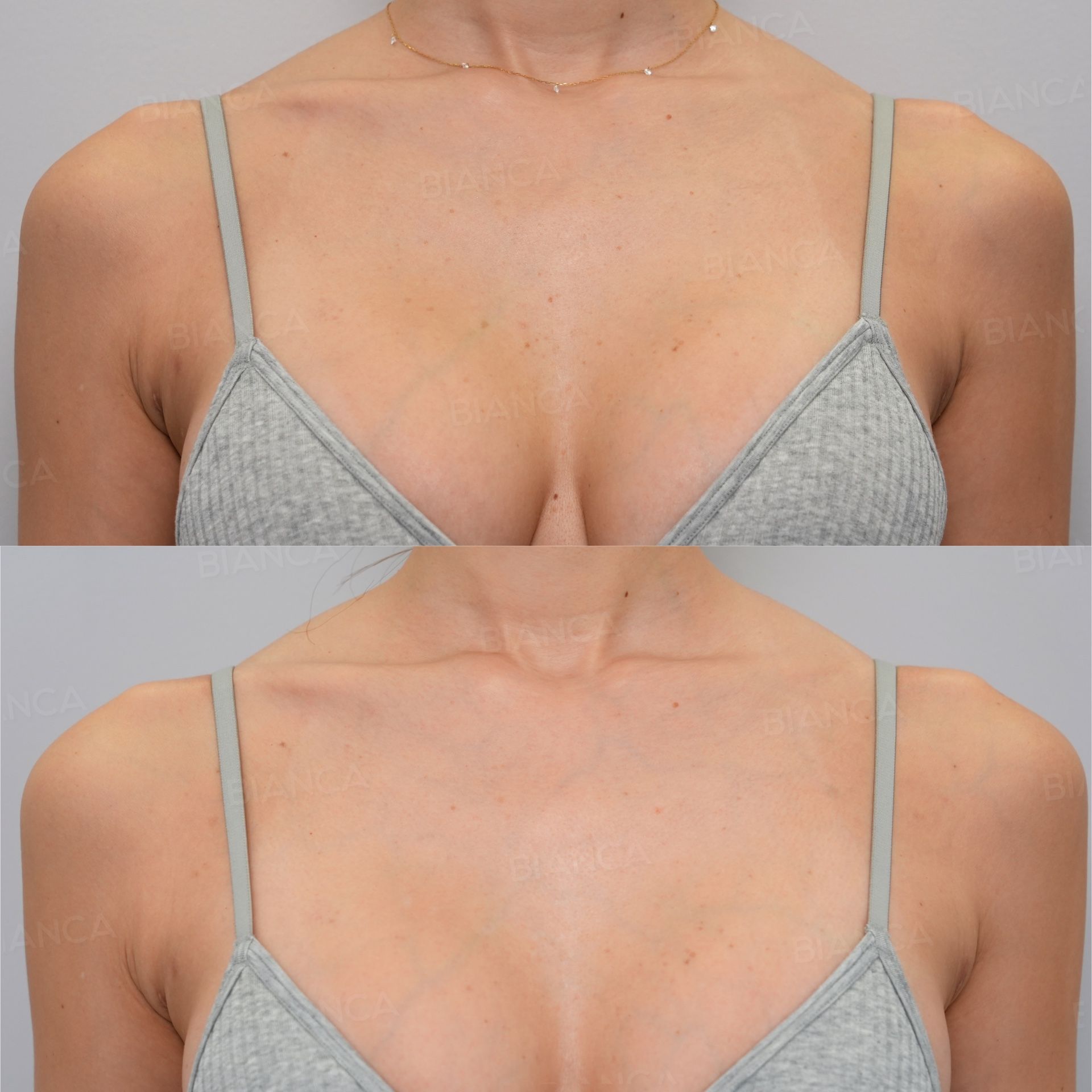 Wart and Spot Removal (Décolletage)