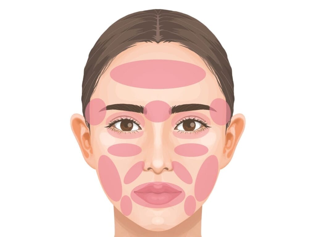 Injection sites for facial fat grafting