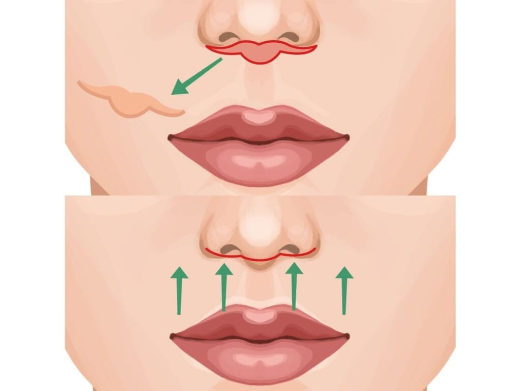 Image illustrating the lip lift procedure