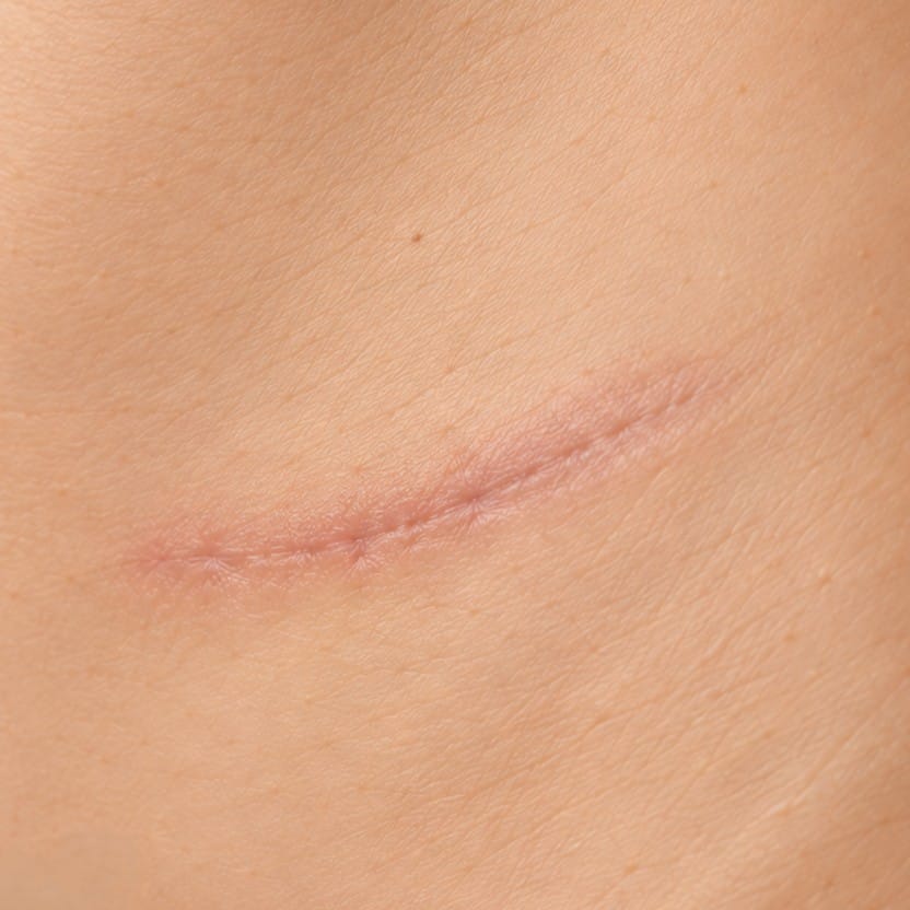 SURGICAL SCARS