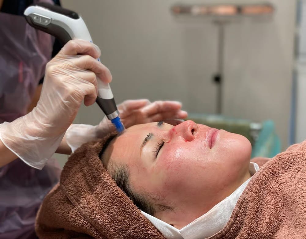 Woman receiving a Dermapen treatment