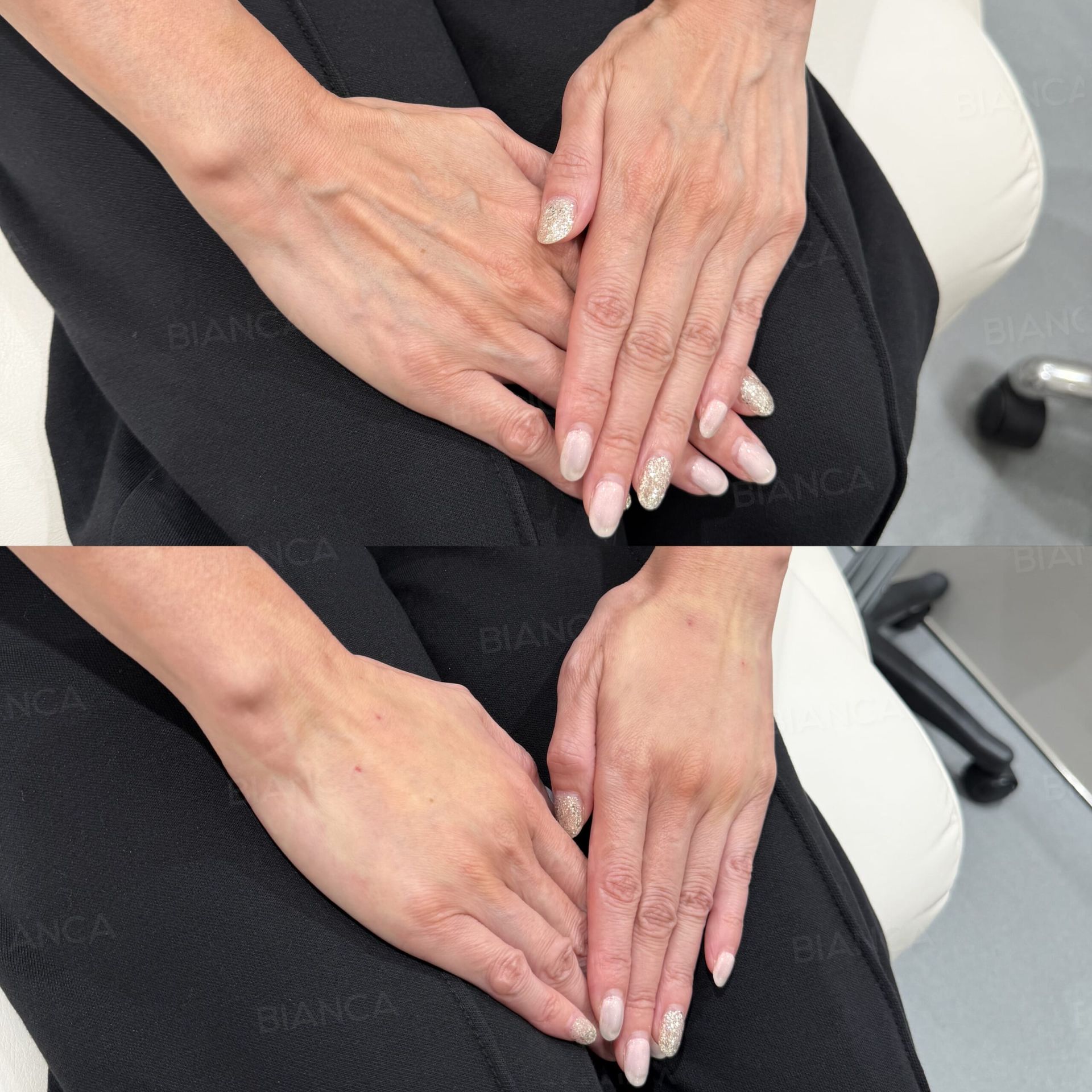 Bianca Clinic: Before and After Treatment Photos