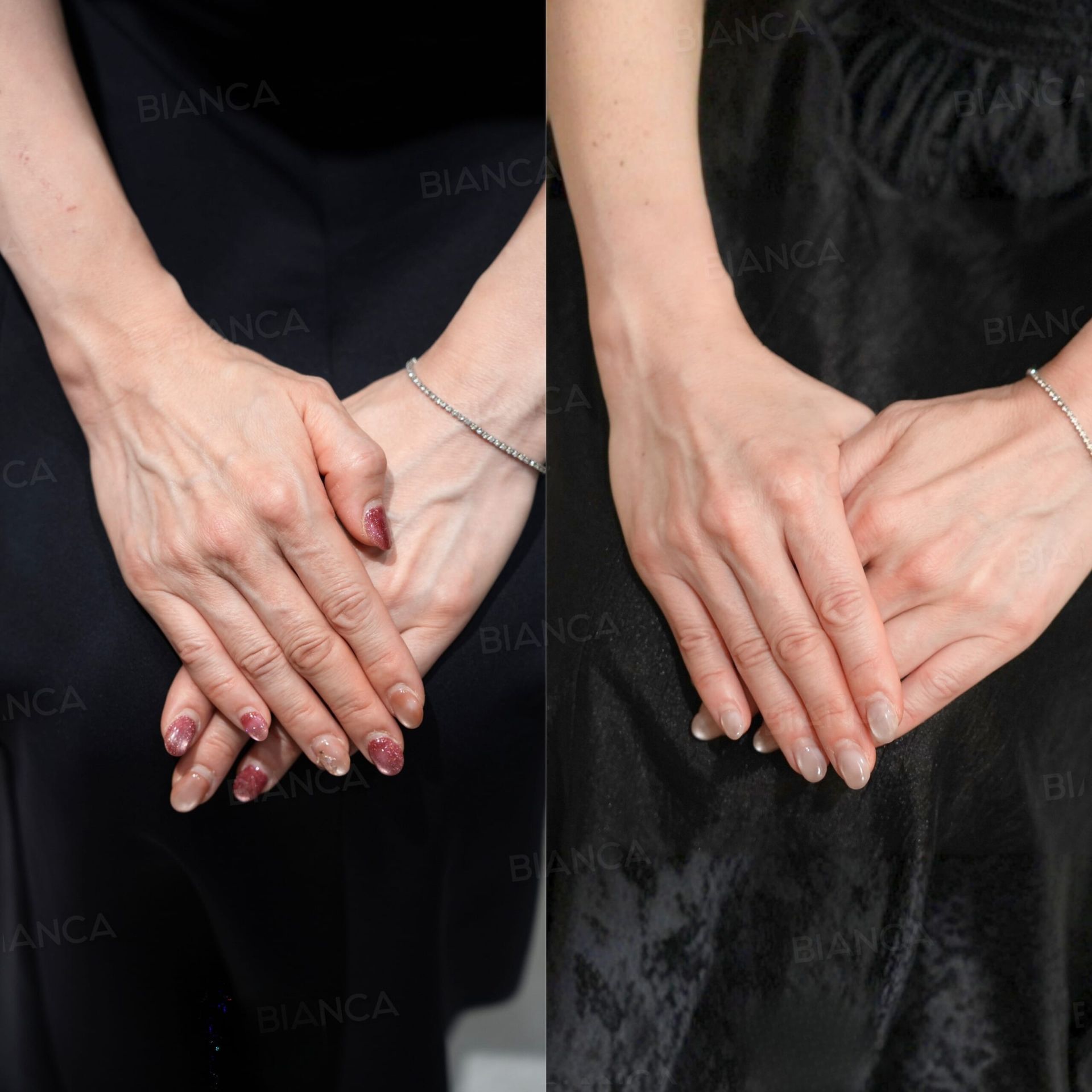 Bianca Clinic: Before and After Treatment Photos