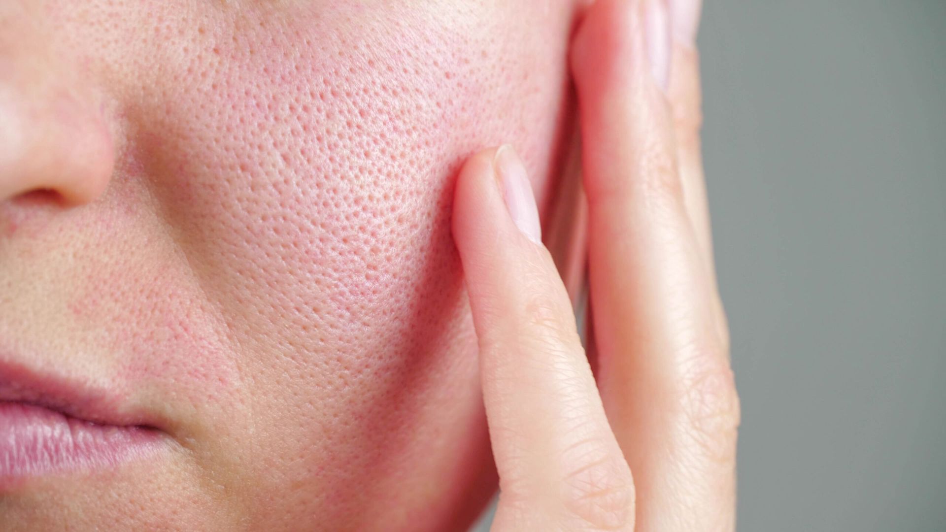 Orange-peel-like skin