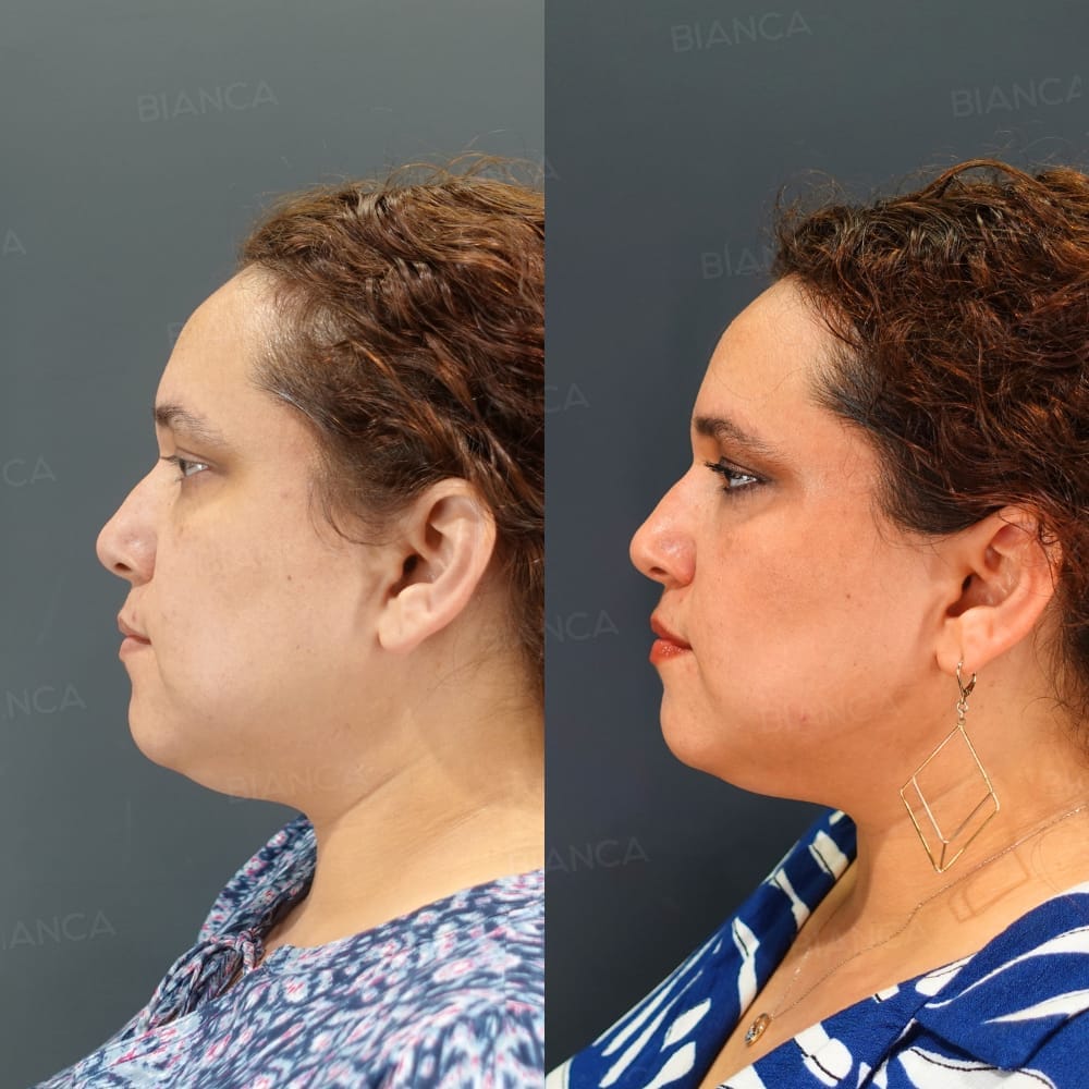 Bianca Clinic: Before and After Treatment Photos