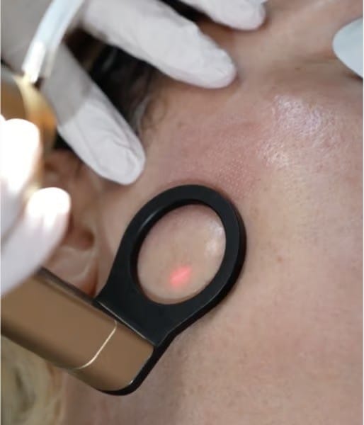 Alma Hybrid laser handpiece in contact with the skin
