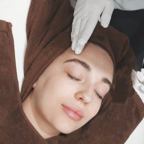 Woman receiving a chemical peel treatment for acne marks