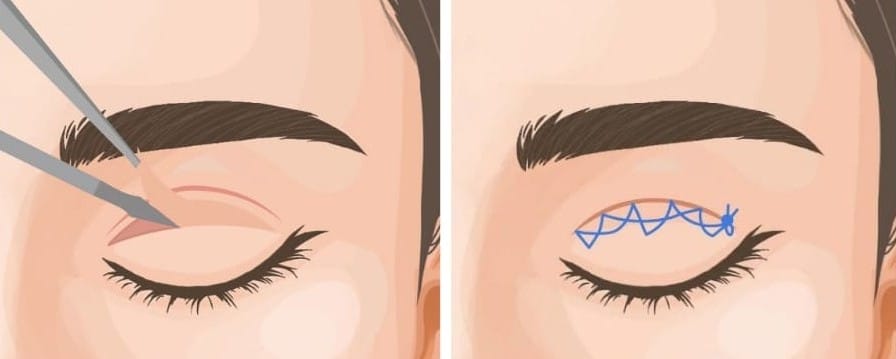 Explanation of Double Eyelid Surgery: Incisional vs. Non-Incisional Methods